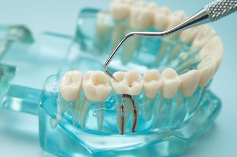 Modelo de acrílico con caries para enseñar al paciente